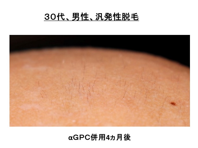 円形脱毛症　病院